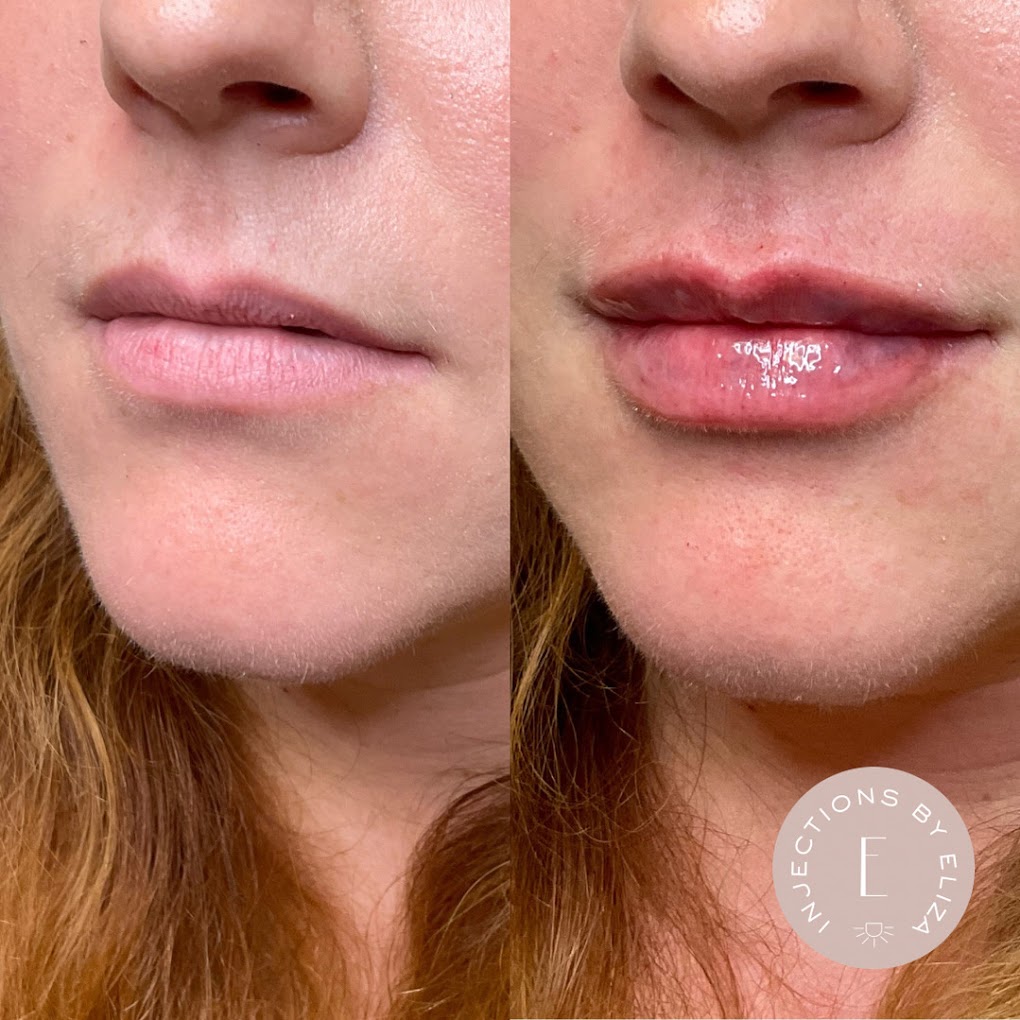 Lip Enhancement Results