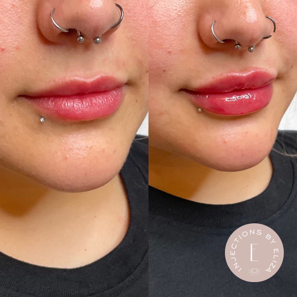 Facial Rejuvenation