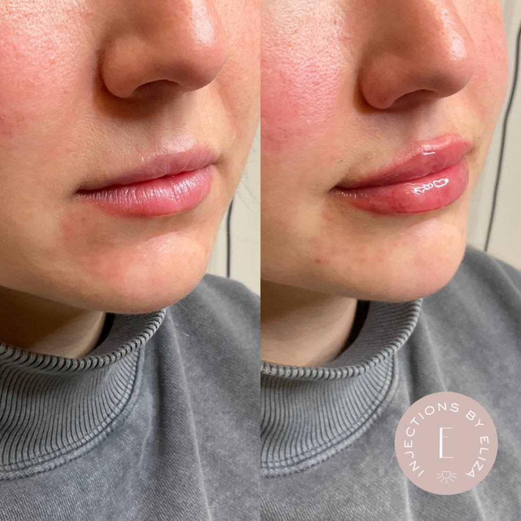 Anti-Aging Treatment