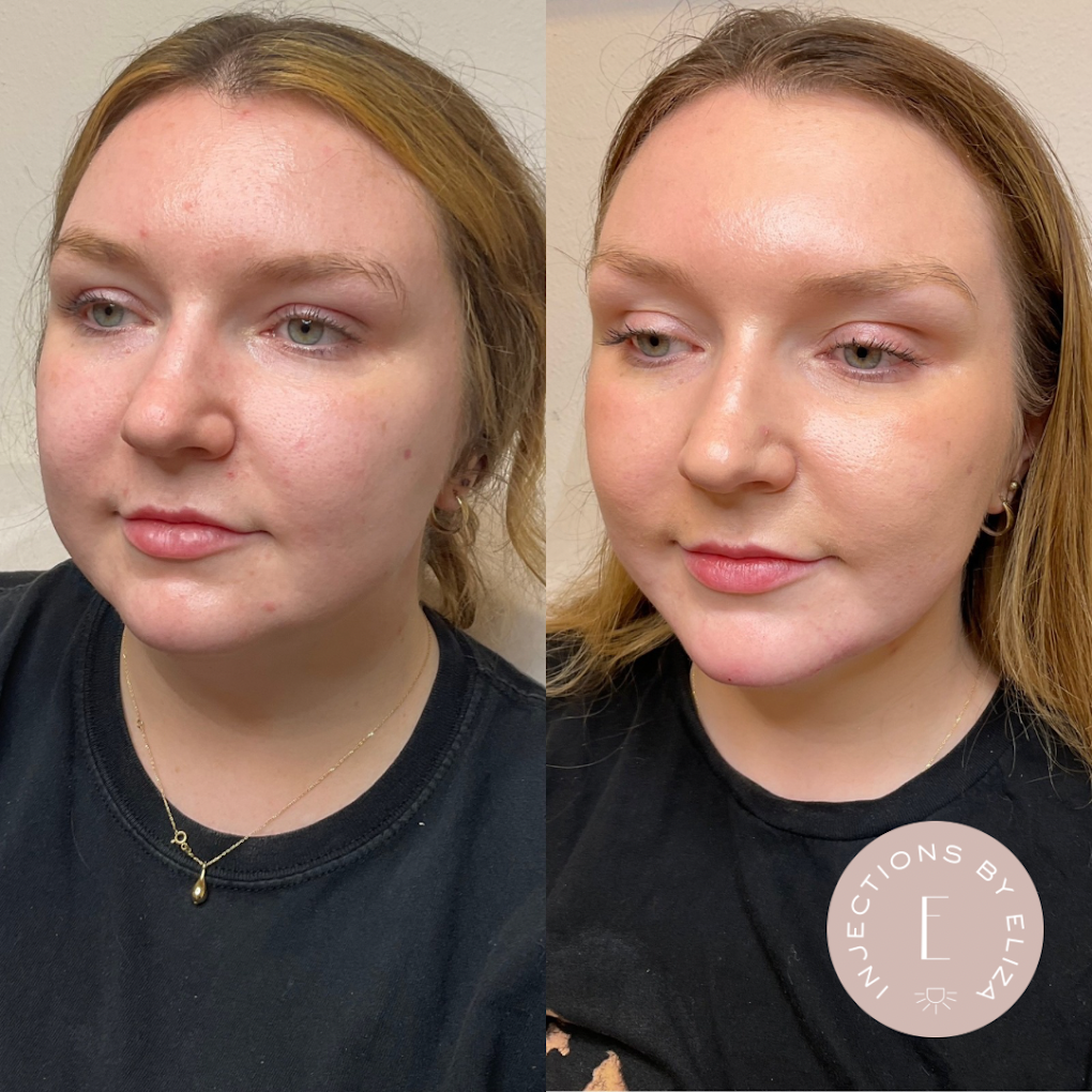 Advanced Treatment Results