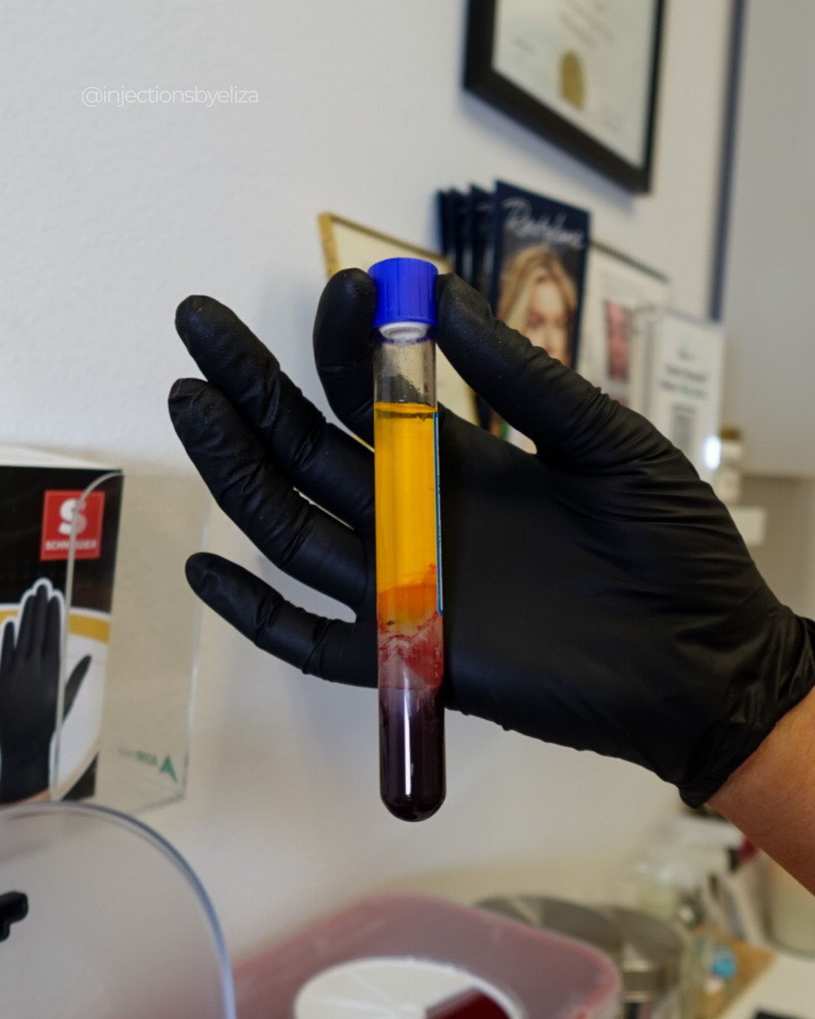 PRP (Platelet-Rich Plasma)